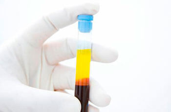 Plasma-rich-in-factors-of-growth
