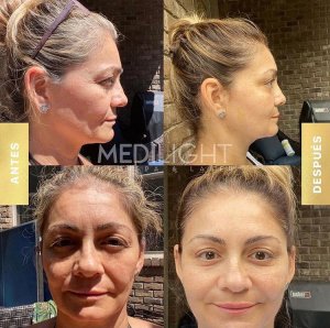 Facial Lifting