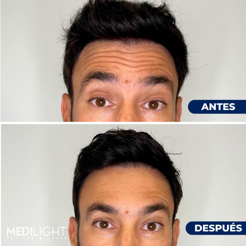 Resultados naturales de lifting líquido inyector certificado Miami