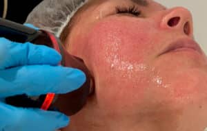 Radiofrecuencia tripolar