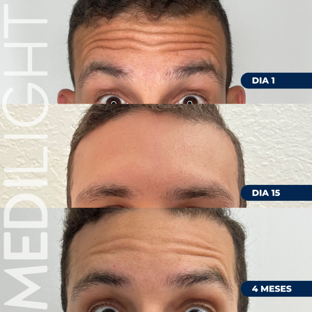 Resultados naturales de tox en frente Medilight Doral Miami