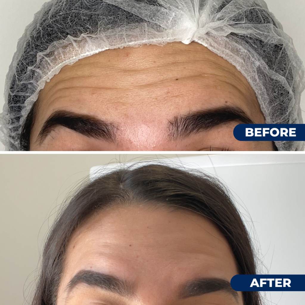 Antes y después de relleno de labios Medilight Coral Gables Miami