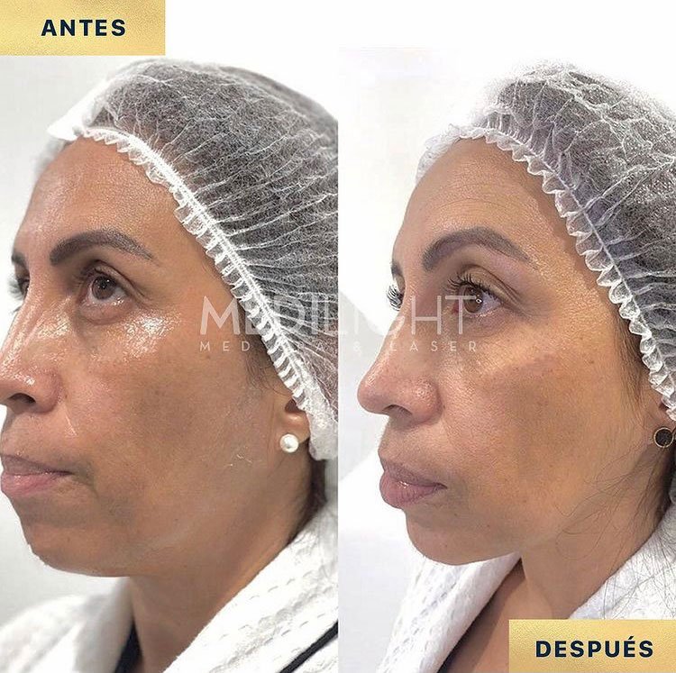 Facial Lifting