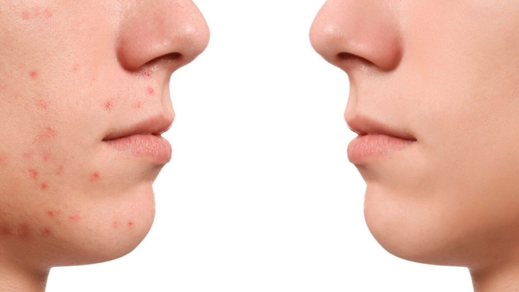 How to reduce facial spots?