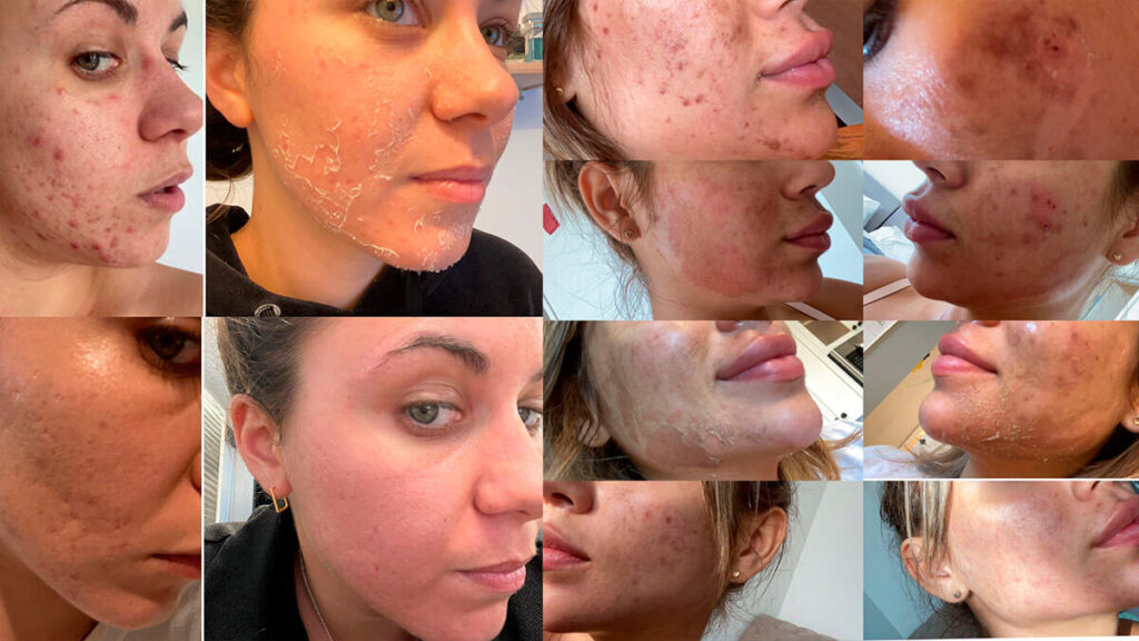 Treating Acne