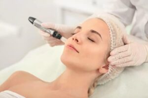 microneedling