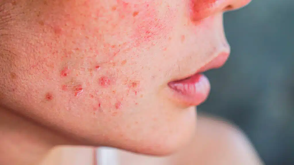 Frequent Appearance of Blackheads