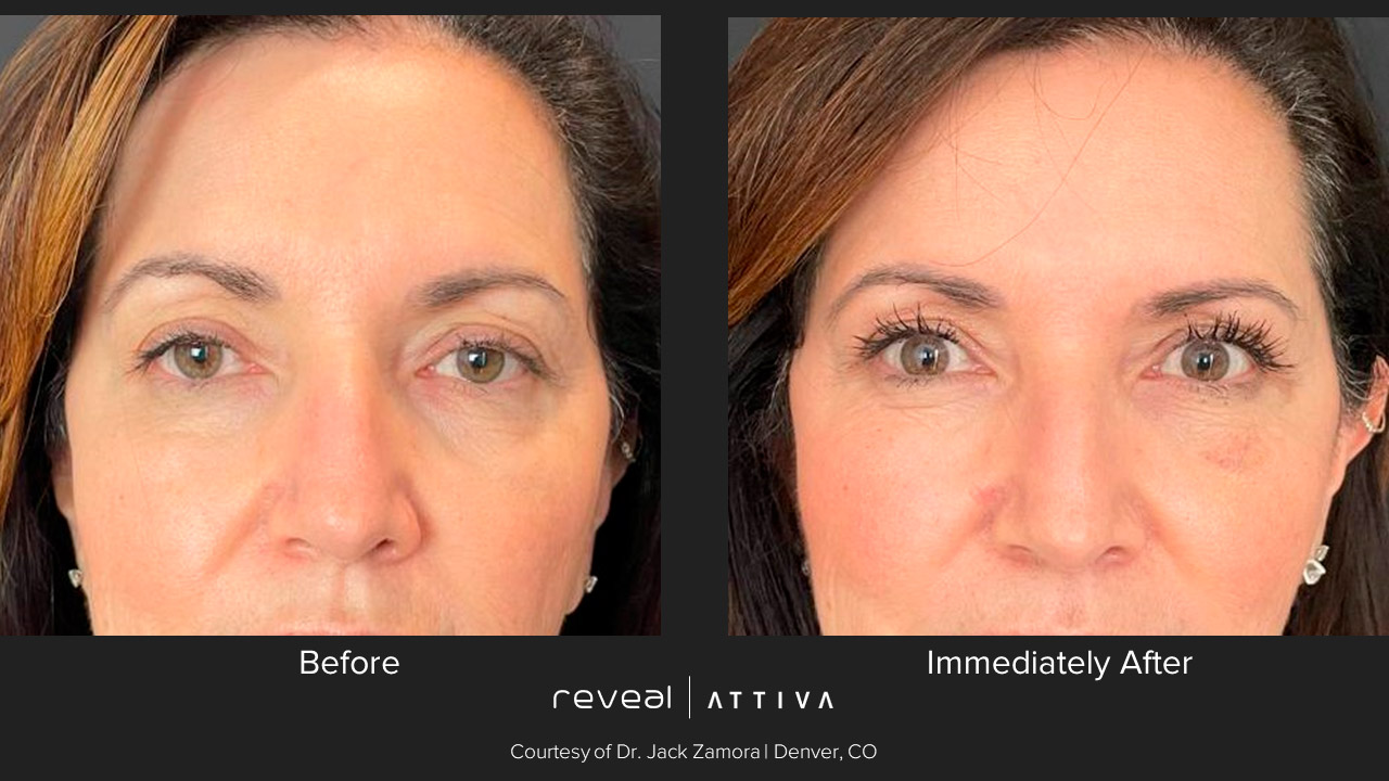 ATTIVA