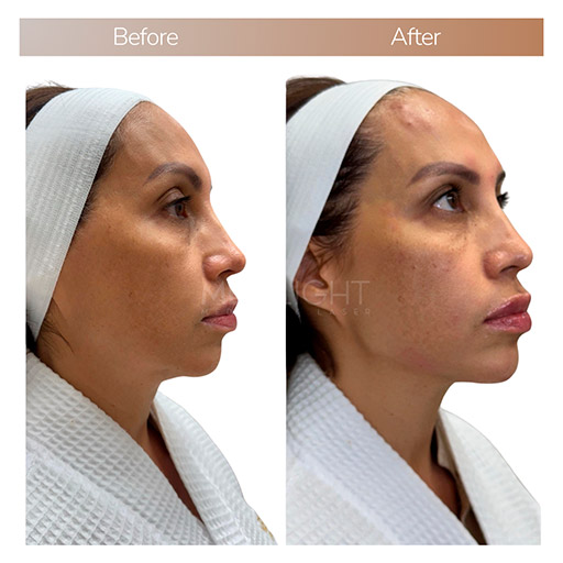 facial harmonizatio