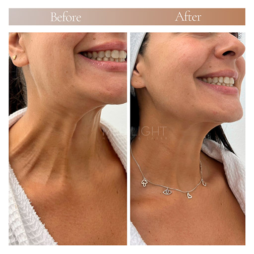 botulinum toxin