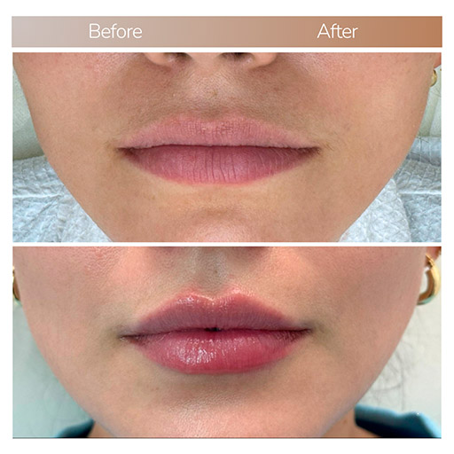 hyaluronic