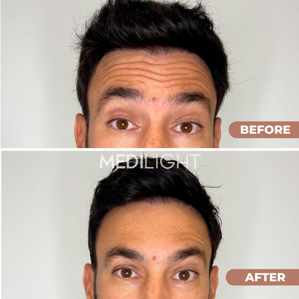 antes y despues