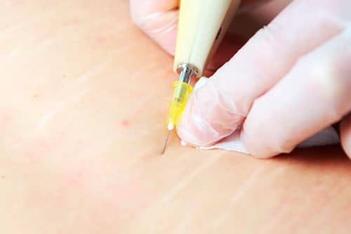 carboxiterapia carboxiterapia